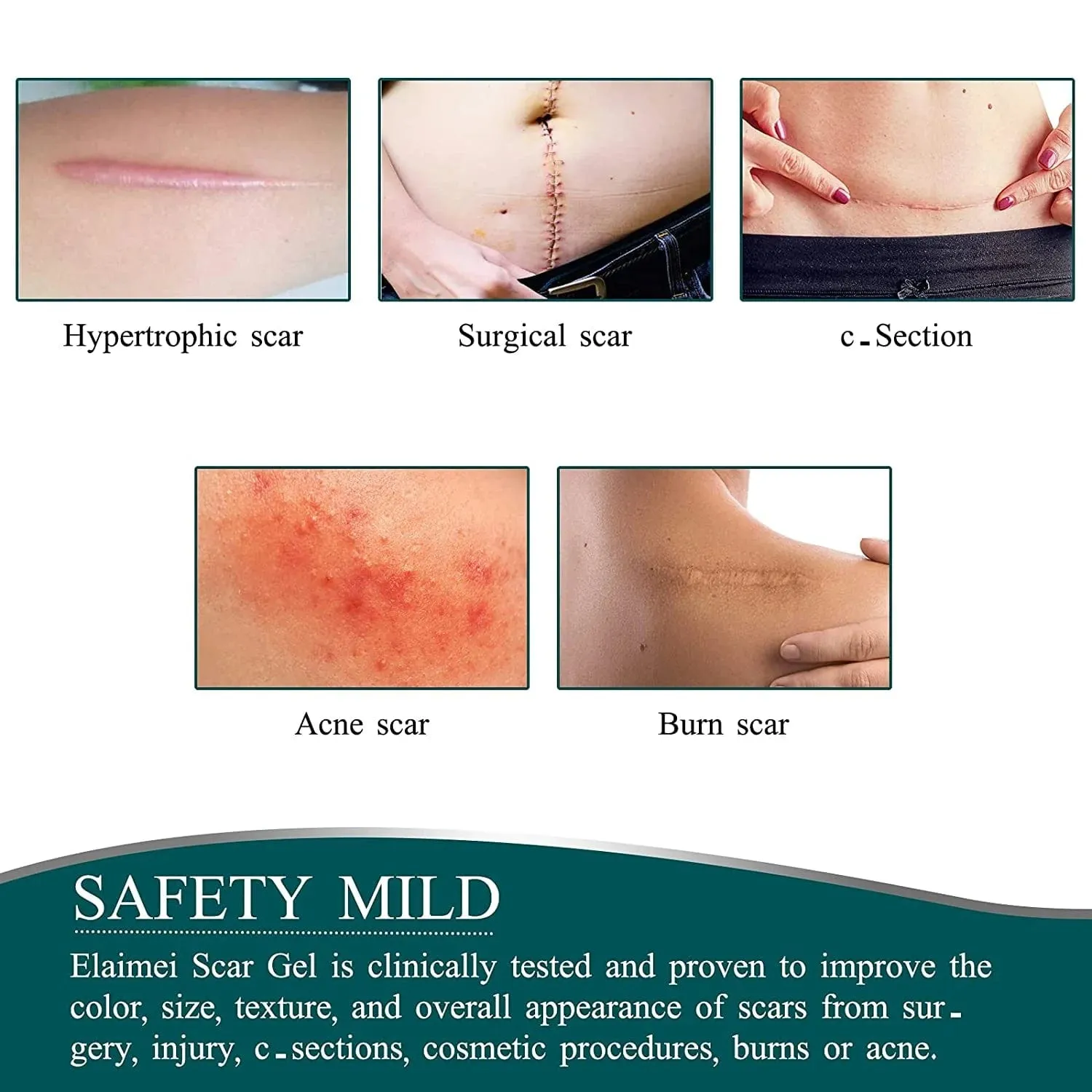 Dermoxy™️ Scar Removal Tape